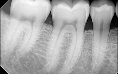 Danger des radiographies dentaires?