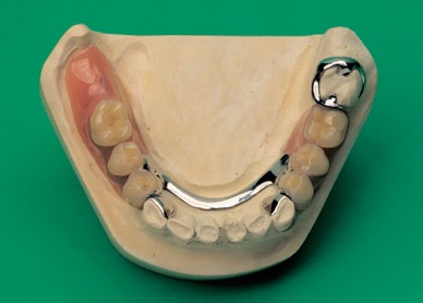 Prothèse dentaire avec attachement